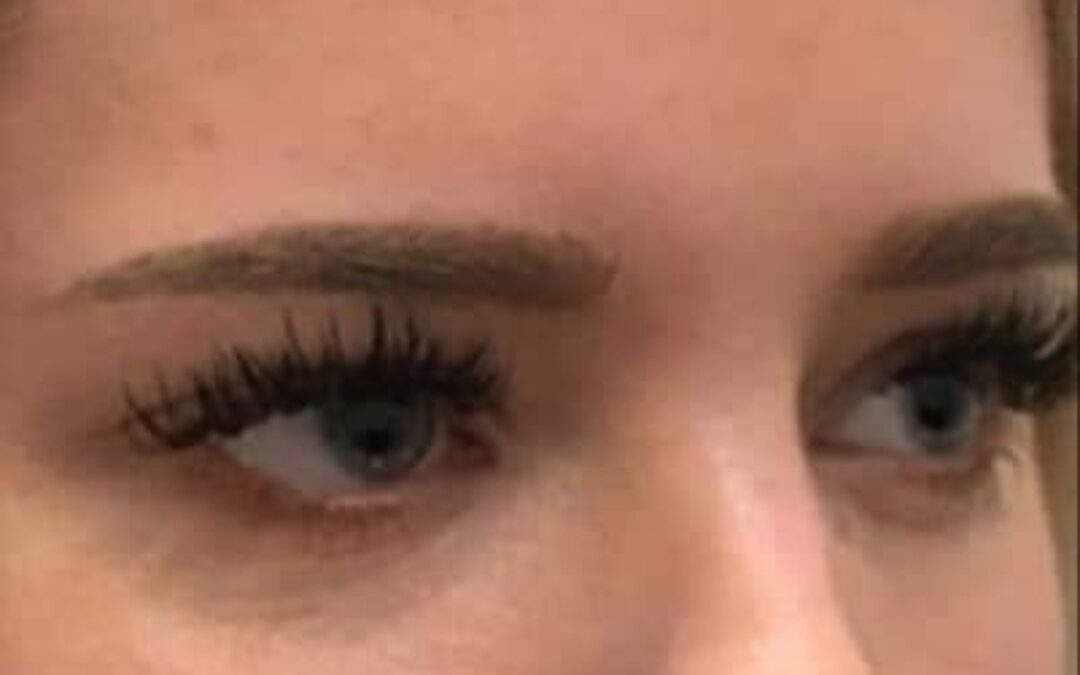 Anti Wrinkle Injections